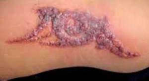 Les risques liés aux tatouages